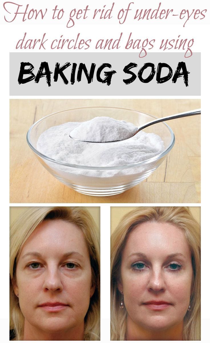 [ad_1]

How to get rid of under-eyes dark circles and bags using baking soda – Weight loss mag
Source by hasen001
[ad_2]
			
			…